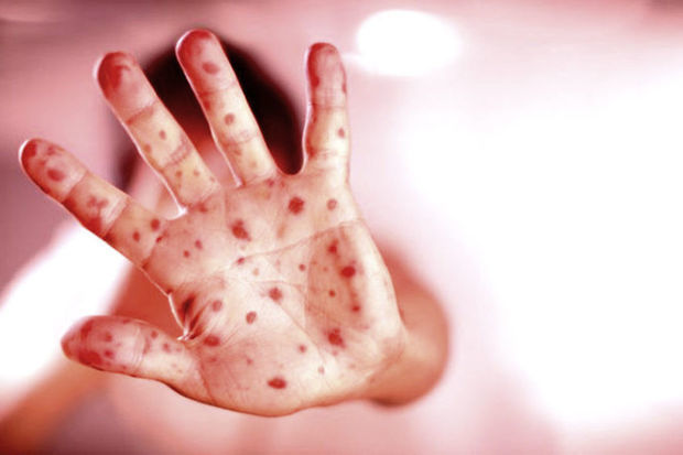 Tovuzda azyaşlı xəstəxanada qızılcadan ölüb